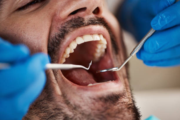Best Emergency Dentist for Lost Fillings or Crowns in Indian Hills, CO